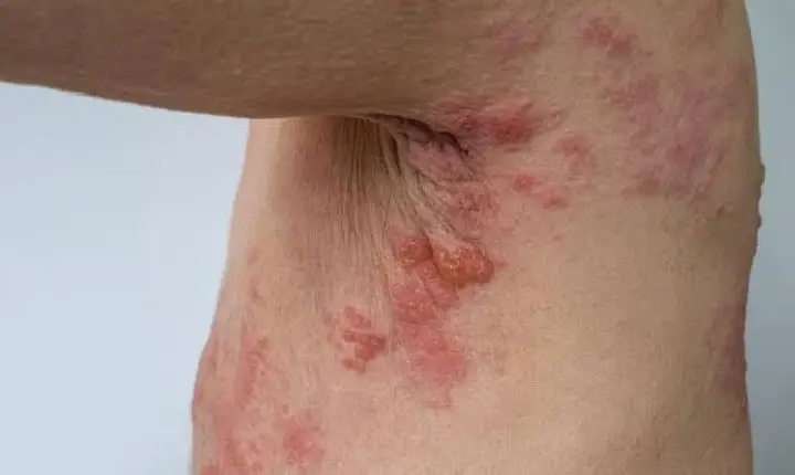 Brasil Vive Surto De Herpes Zoster, E Vacina De Mais De Mil Reais Não É Oferecida Pelo SUS