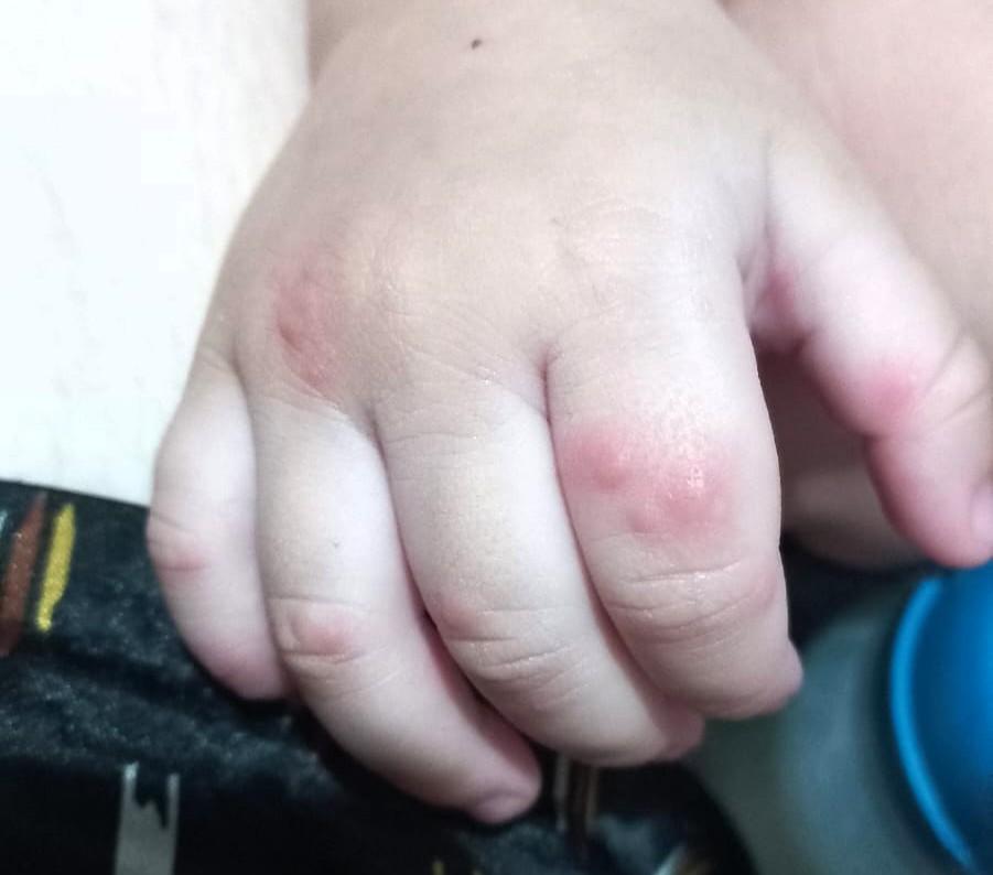 Mão-pé-boca: FVS-RCP reforça cuidados contra a doença